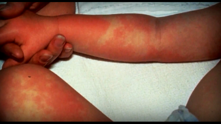 Inflammatory Disease In Children Children S National Hospital Dc Wusa9 Com