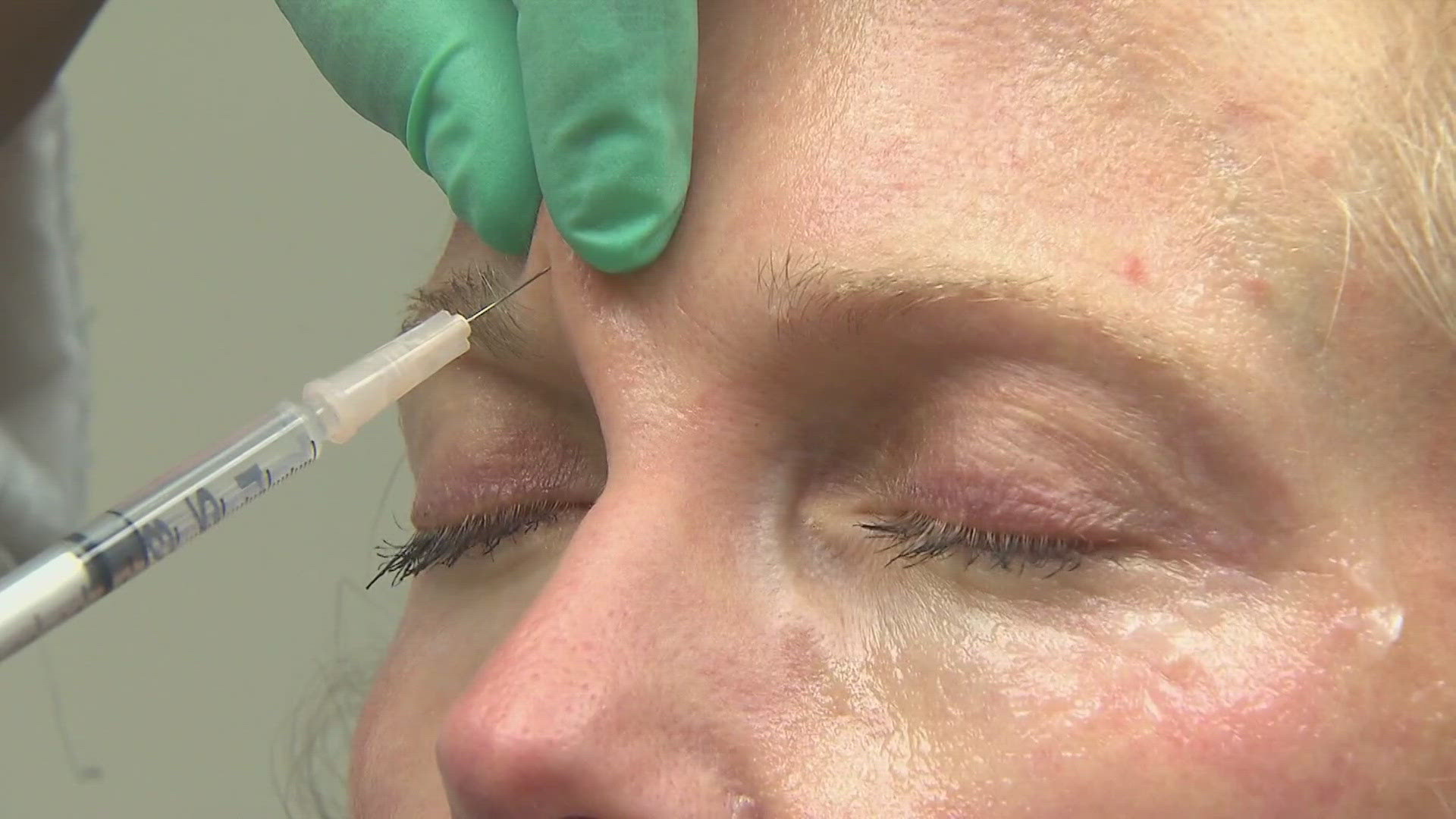 glp 1 and botox Botox results alter while on GLP-1 weight-loss drugs, study says