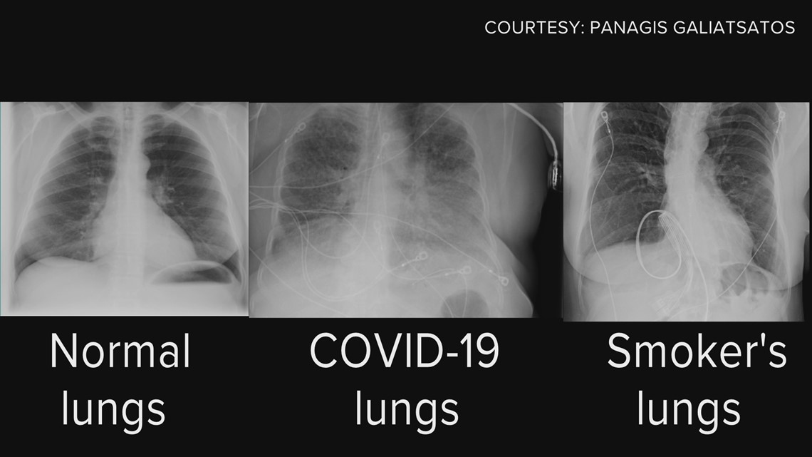 Lungs after covid