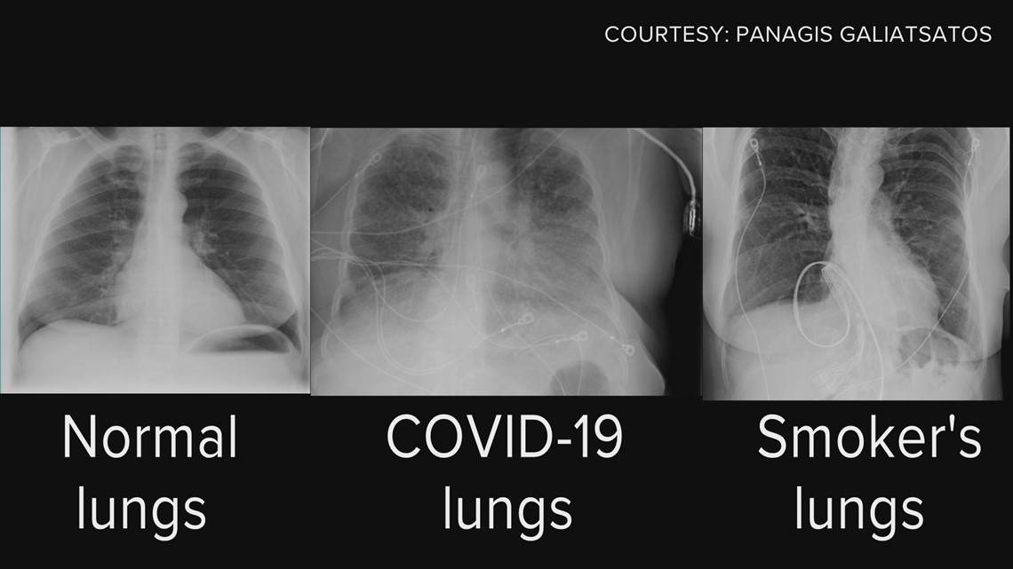 Healthy Lungs Vs Smokers Lungs X Ray Healthy Lungs Vs Smokers Lungs X Ray