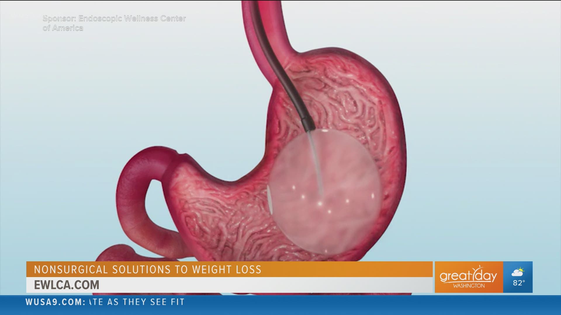 Endoscopic Options for Weight Loss