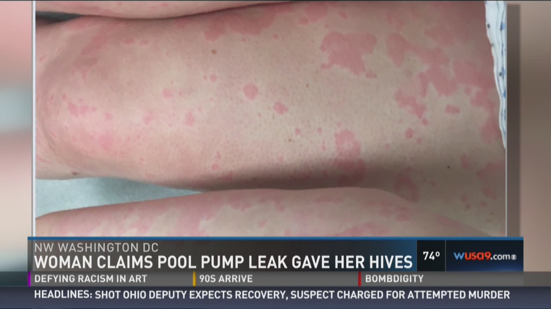 Woman says apartment's leaking pool pump gave her hives
