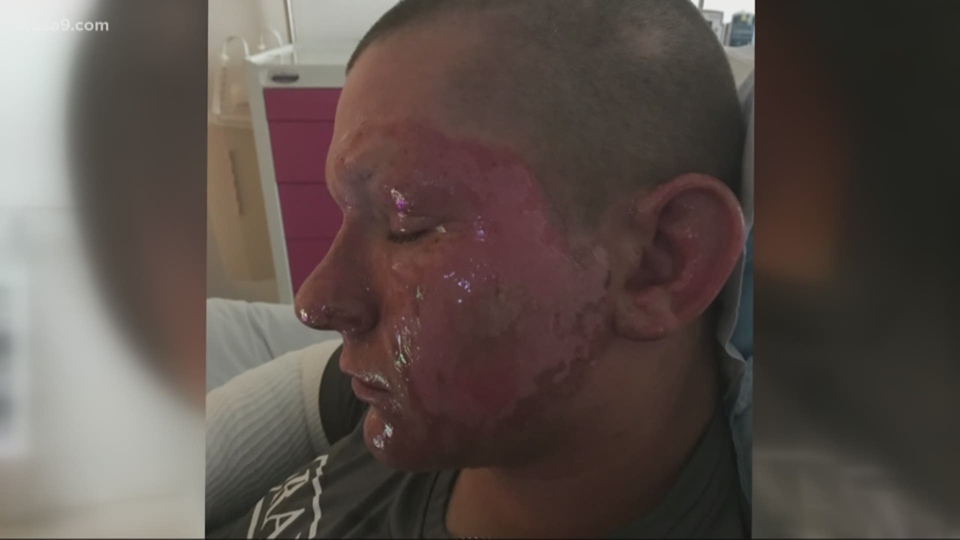 The Virginia teenager severely injured by giant hogweed one week ago, is home from the hospital recovering after the toxic plant removed chucks of his skin.   