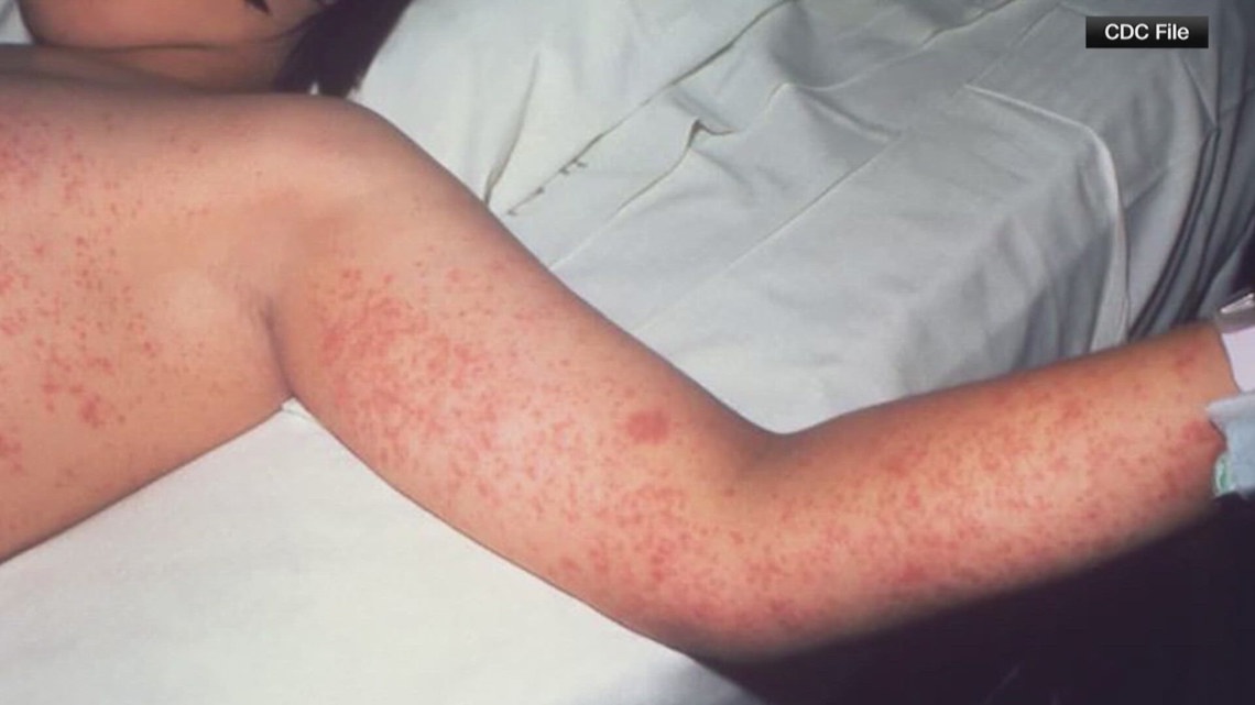 Virginian with measles may have exposed others in Bethesda, Maryland