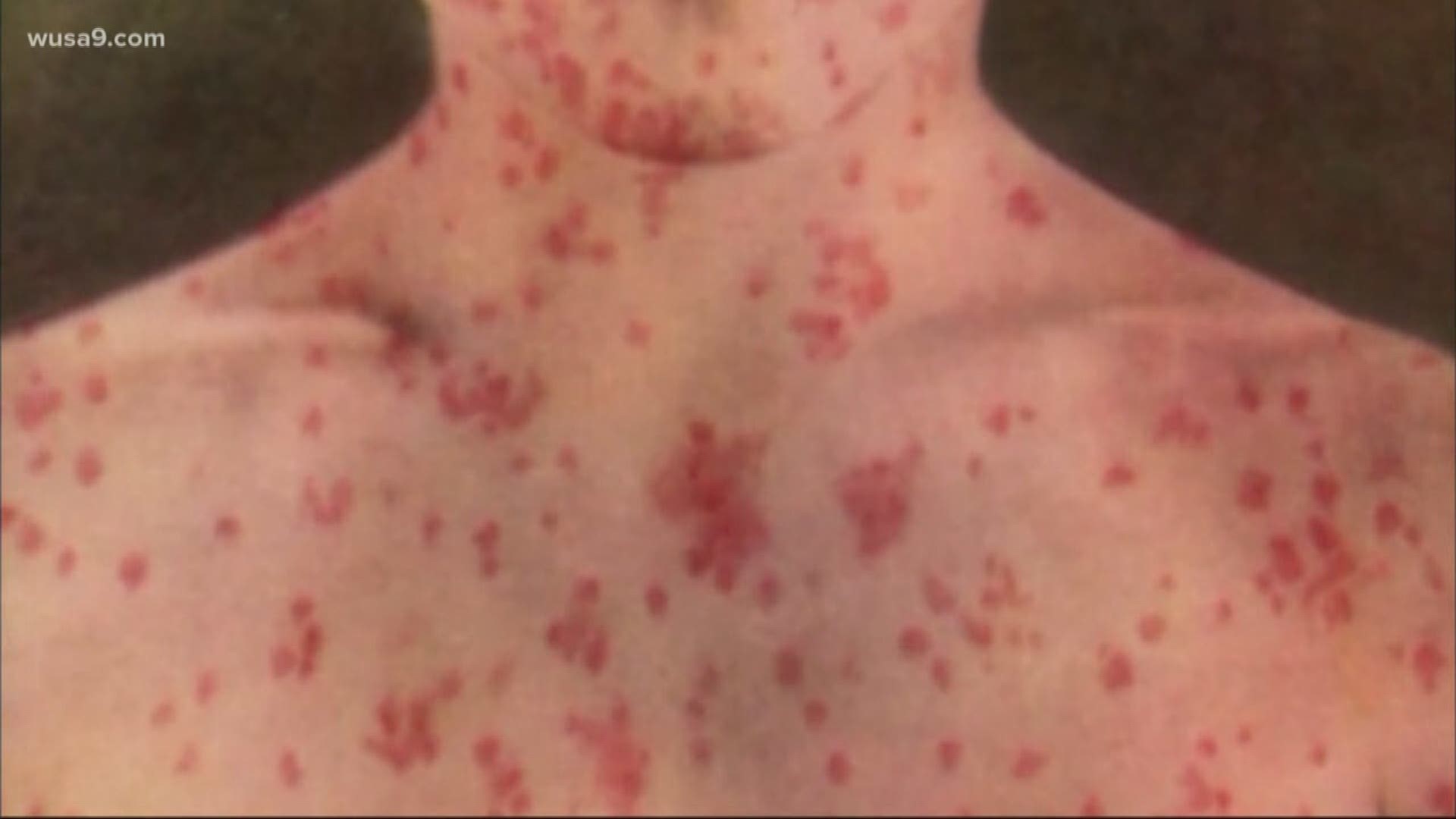 Health officials in St. Mary's County Maryland have gone silent after announcing they have a suspected case of measles that has turned up in the hospital there.