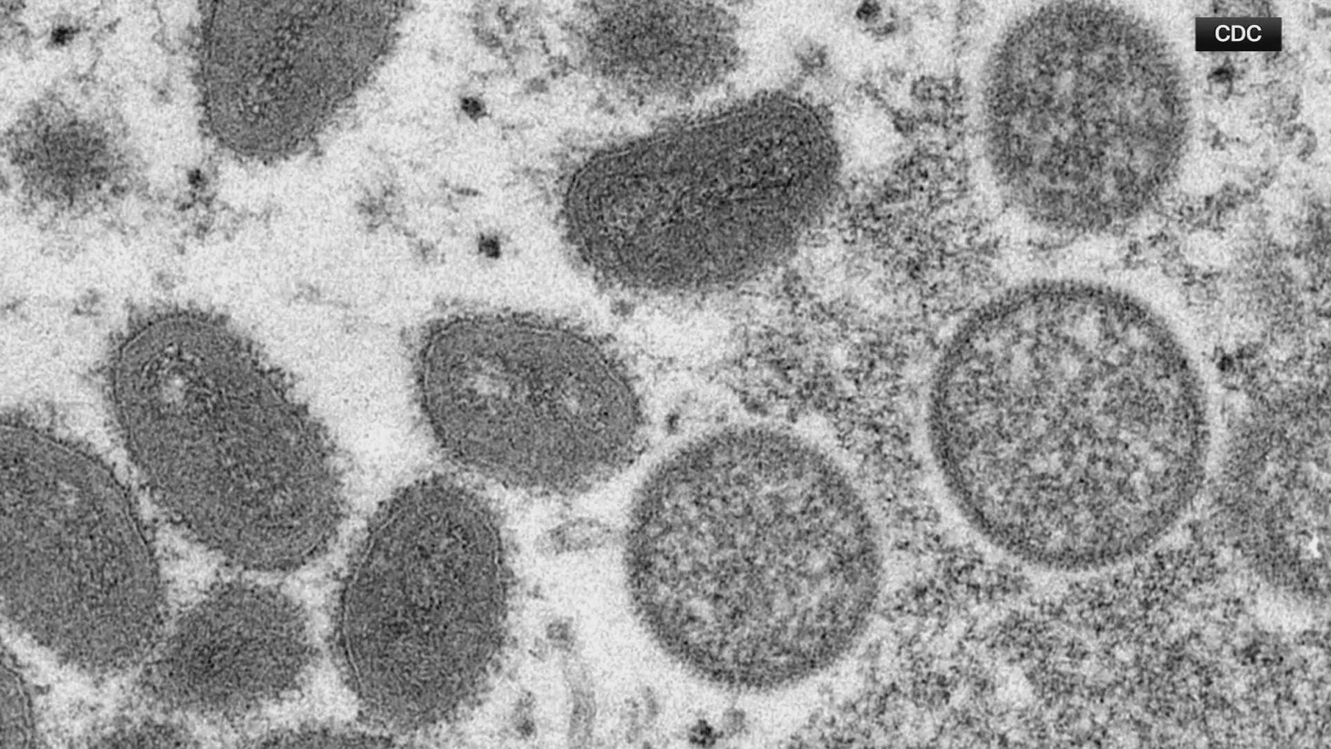 The agency says a new version of the infectious disease formerly know as Monkeypox has become deadlier.