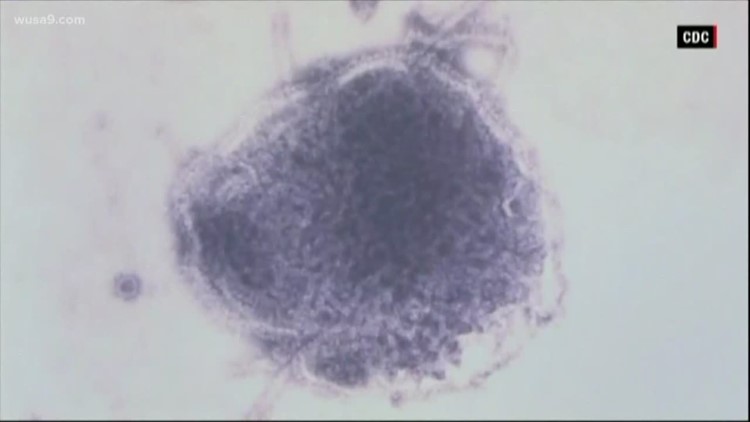 Measles case confirmed in Montgomery County; Officials urge residents to monitor possible symptoms