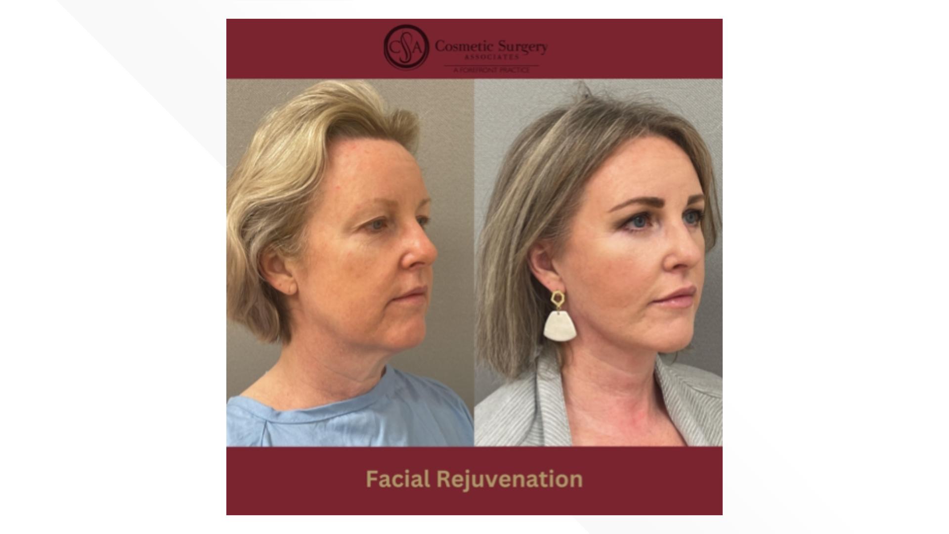 Sponsored by: Cosmetic Surgery Associates. Dr. A. Dean Jabs, Board Certified Plastic Surgeon, tells us everything we need to know about facial rejuvenation.