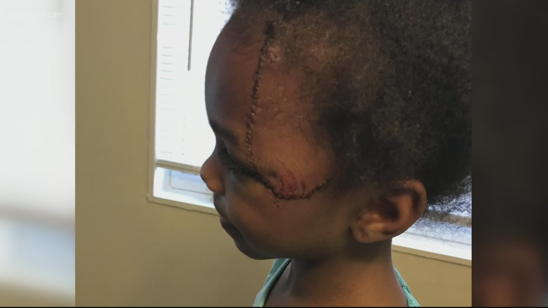The father has a broken ankle, his eight-year-old has a broken leg and the six-year-old will need multiple surgeries to repair the damage to her face.
