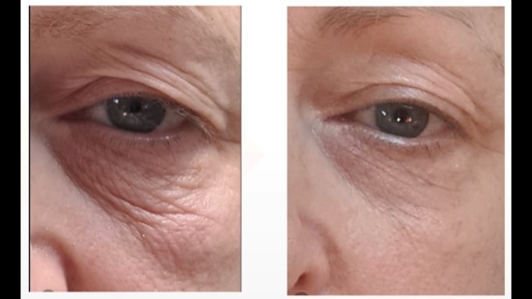 Sofwave offers non-invasive treatments to soften fine lines & wrinkles
