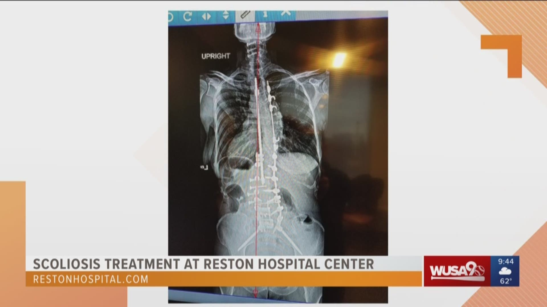 Barbara Jones explains how the scoliosis treatment she received at Reston Hospital Center helped her get back on her feet.  Sponsored by Reston Hospital Center.